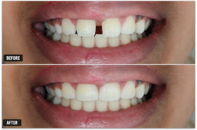 Gap between front teeth, before and after