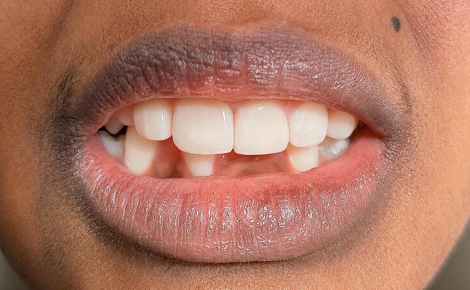 After: the space between the upper front teeth is closed