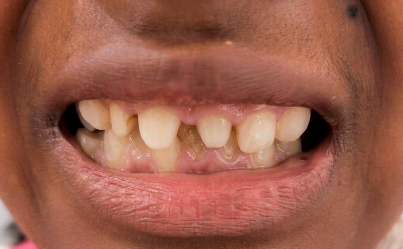 Before: a space between the upper front teeth
