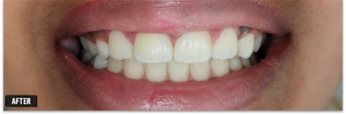 After: the space between the upper front teeth is closed