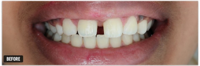 Before: a gap between the upper front teeth