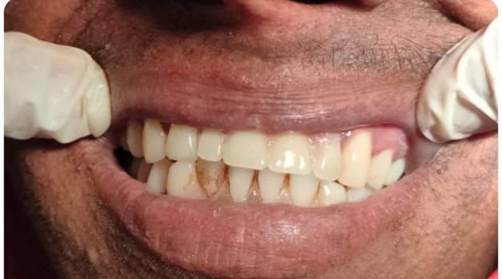 After: a tooth fills the space of the missing upper front tooth