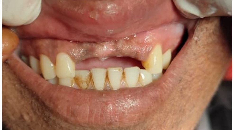 Before: one upper front tooth is missing