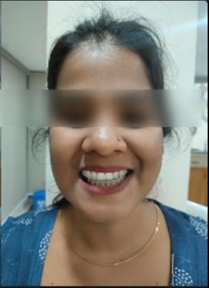 After frame of the smile photograph