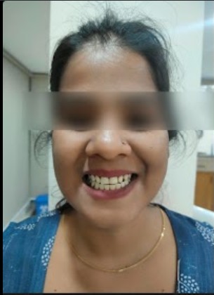Before frame of the smile photograph