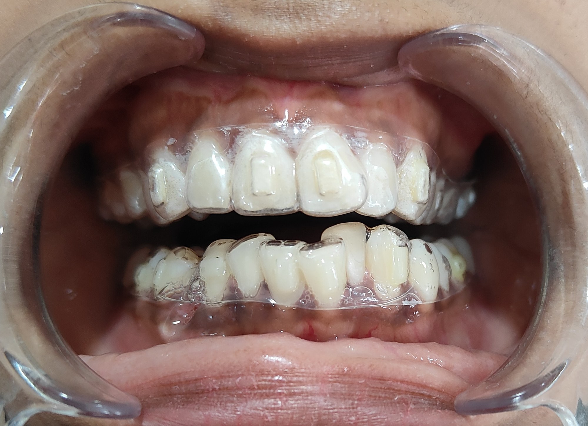 Clear aligners on the upper and lower teeth at Enamel Dental, Argora Chowk.