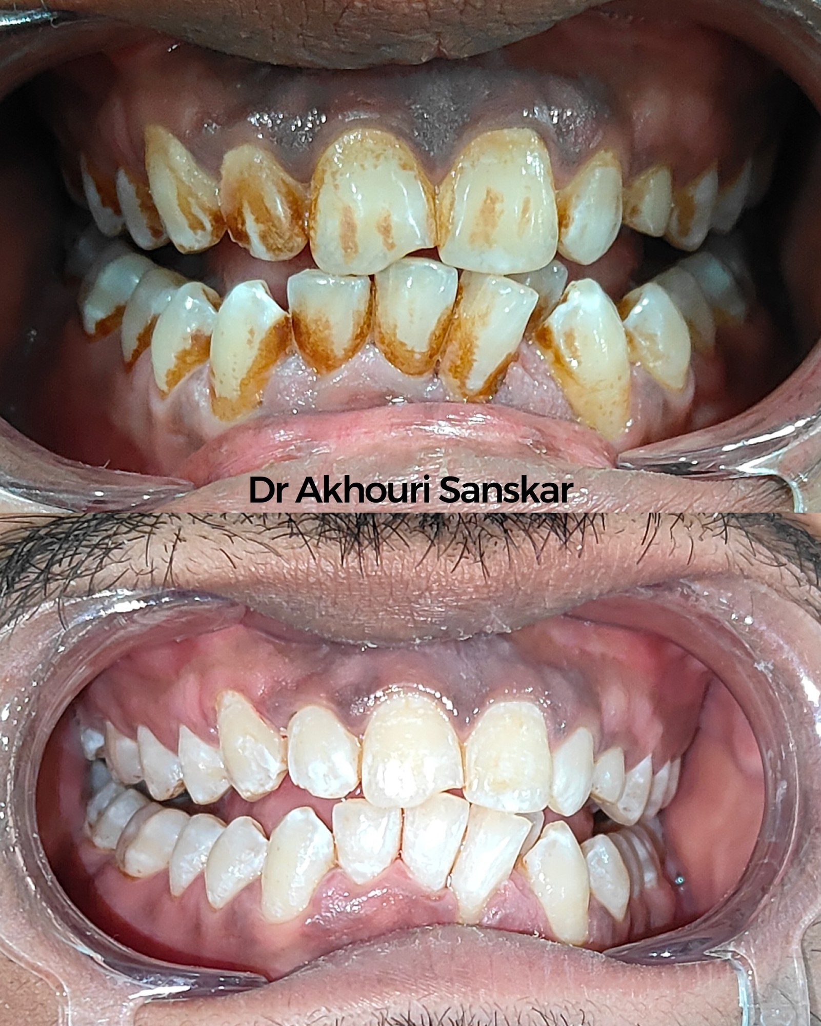 Teeth with heavy brown stains above, and the same teeth lighter below, at Enamel Dental, Argora Chowk.