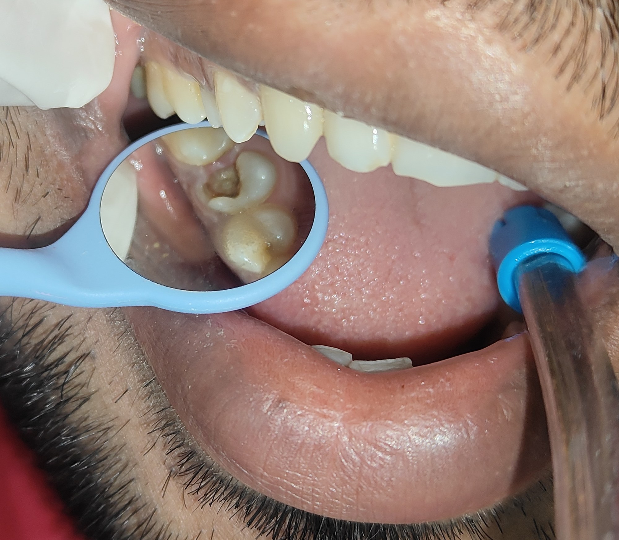 A cavity in a back tooth, shown with a dental mirror at Enamel Dental, Argora Chowk.