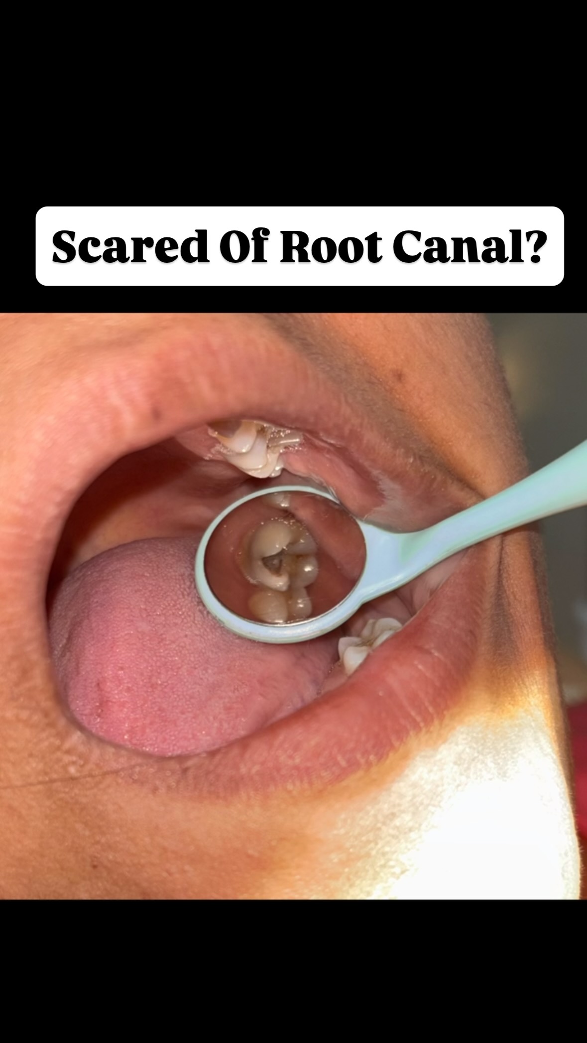 Root canal film still
