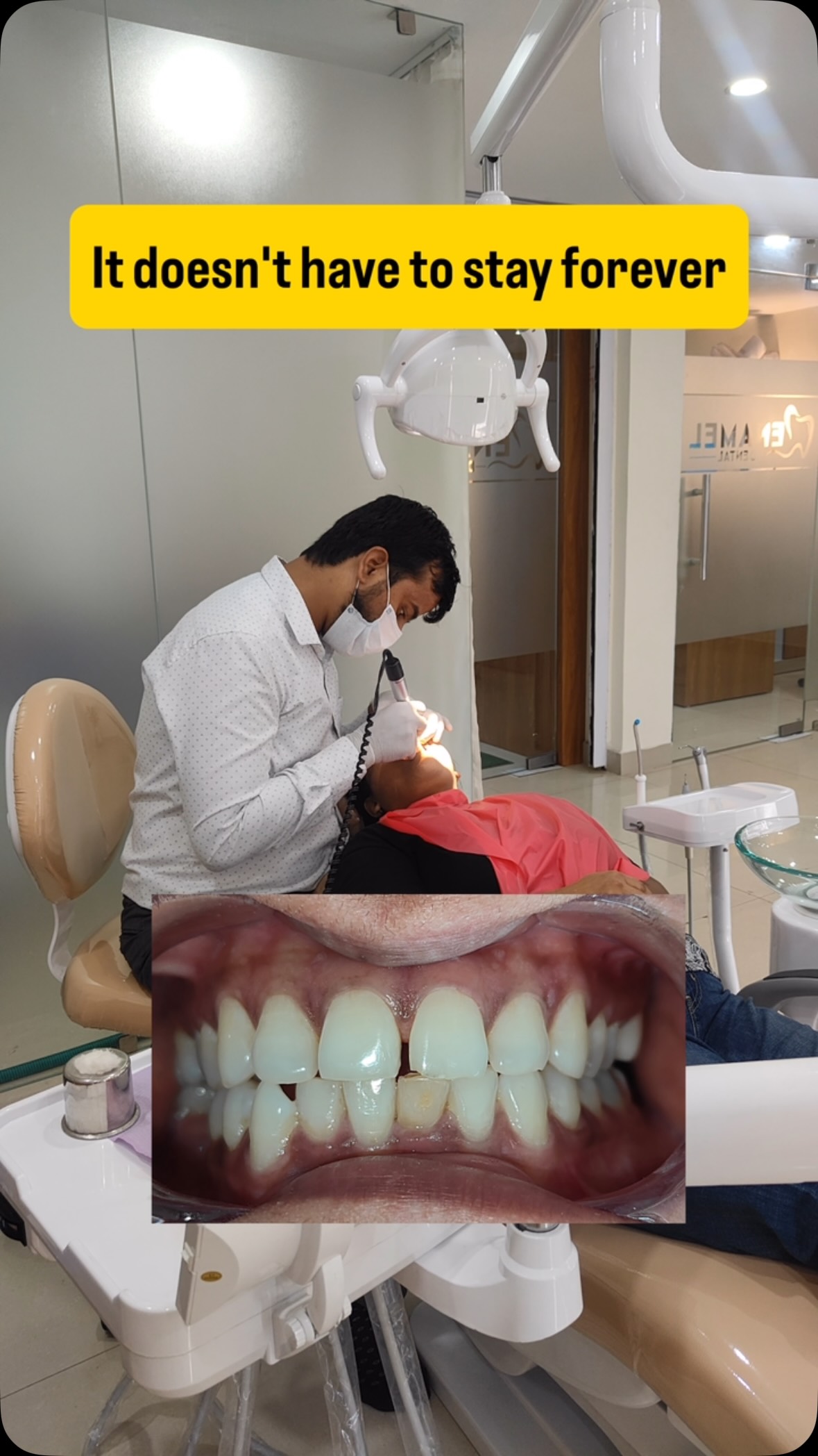 Front teeth reel