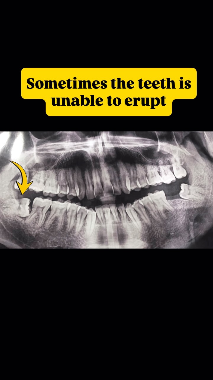 Wisdom tooth reel