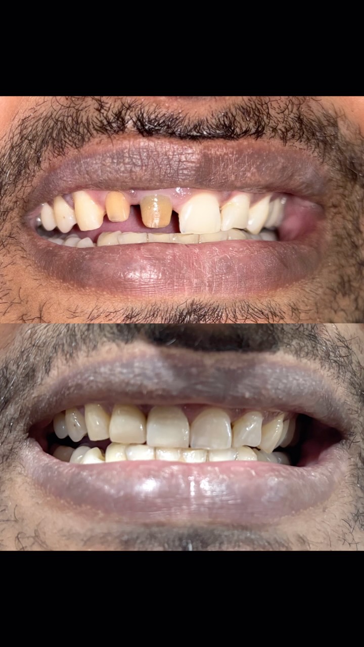Reel about a darkened front tooth